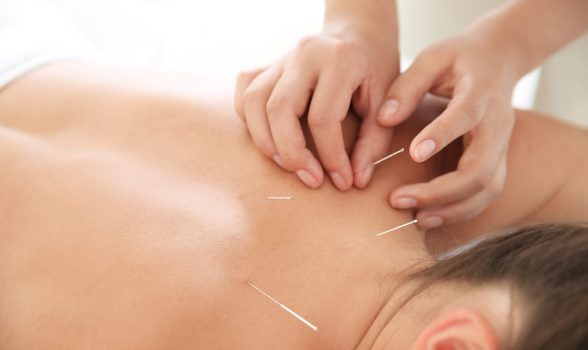 Young woman undergoing acupuncture treatment in salon, closeup